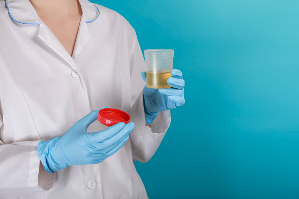 What Should You Avoid Before a Urine Sample?