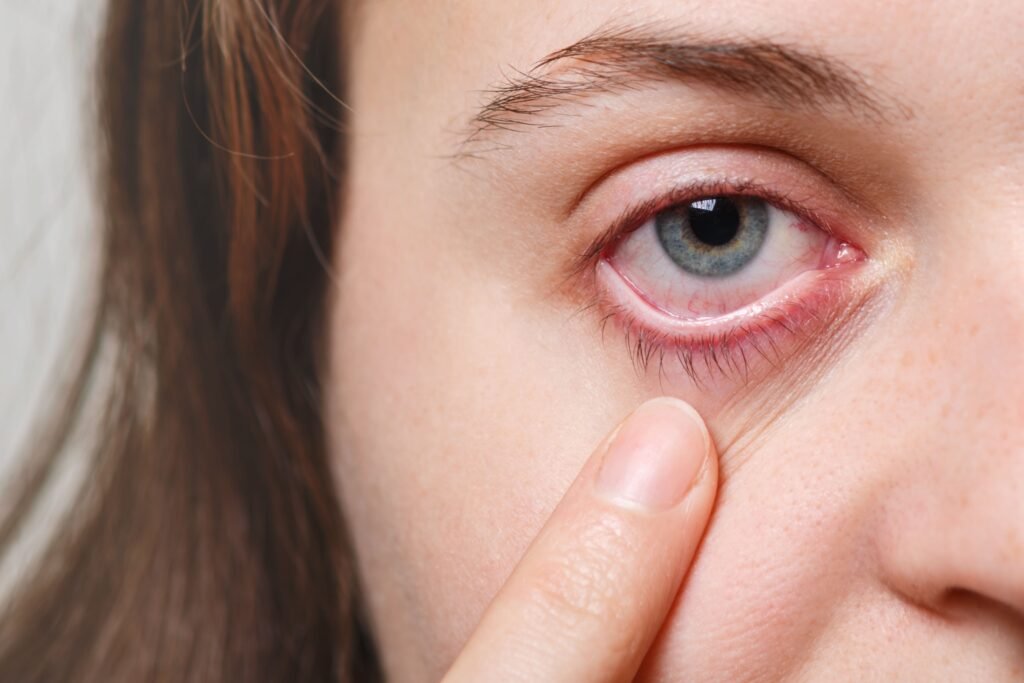 what-is-pink-eye-conjunctivitis