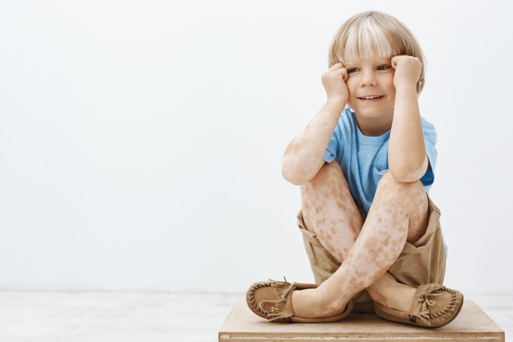eczema-in-kids