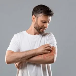 Burns, Rashes & Bites
